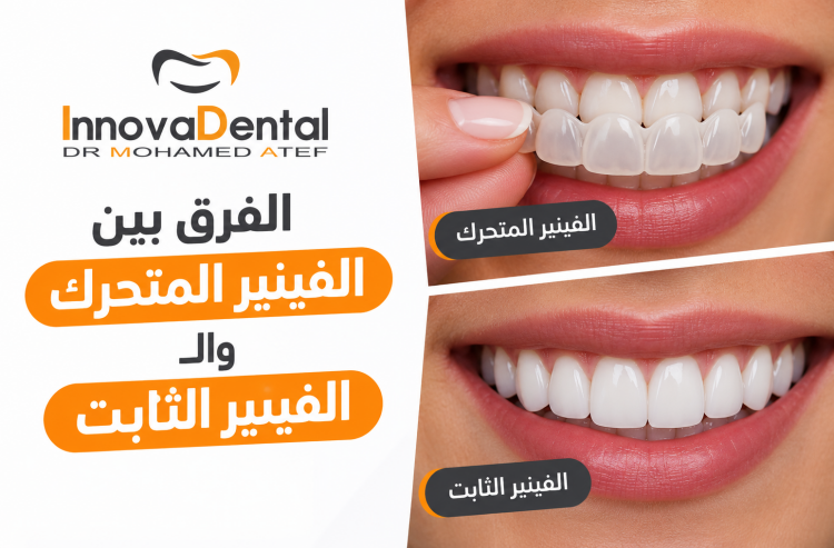 Removable vs. Permanent Veneers: The Ultimate Guide